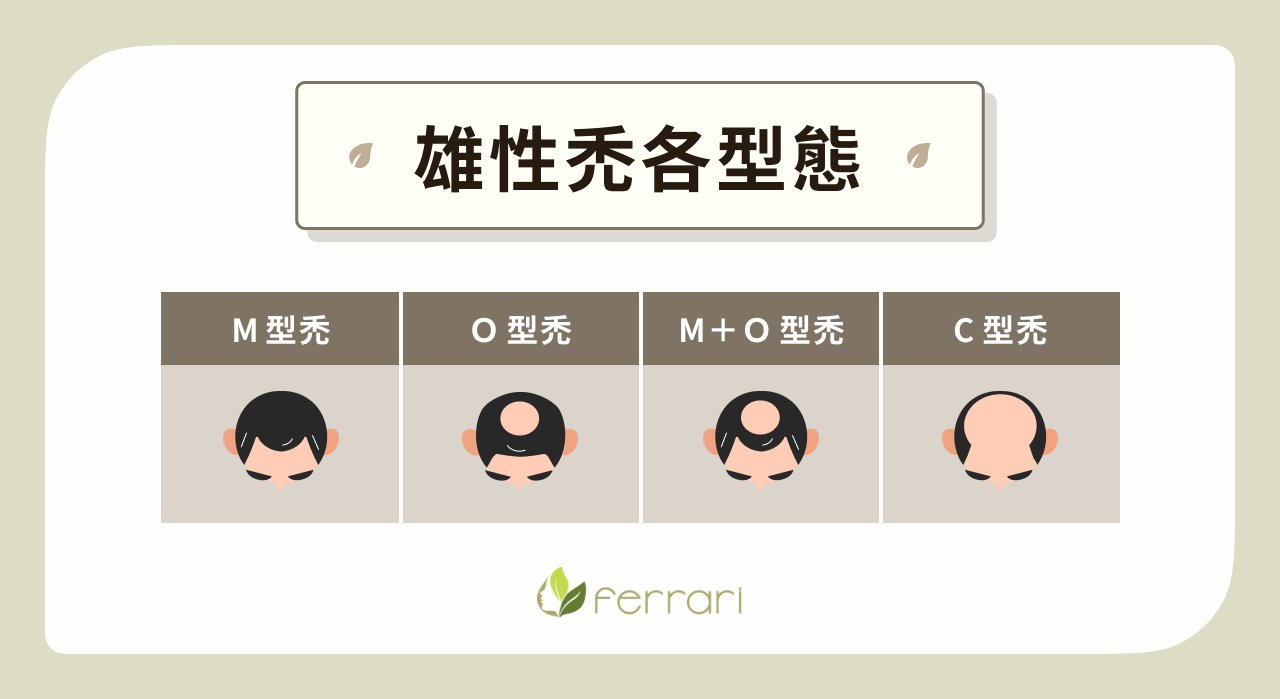 雄性禿各型態